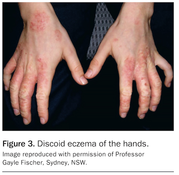 Discoid eczema more than just dermatitis Medicine Today